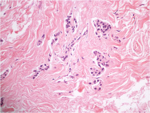Aspectos histopatológicos da biópsia incisional evidenciando agregados epiteliais de células atípicas (Hematoxilina & eosina, 400×).