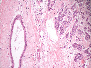 Aspecto histopatológico da biópsia excisional evidenciando tecido glandular mamário ectópico e infiltrado dérmico de células carcinomatosas (Hematoxilina & eosina, 200×).