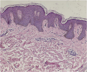 O exame histopatológico revelou discreta hiperceratose, acantose, alongamento e fusão das cristas epidérmicas, com hiperpigmentação da camada basal (Hematoxilina & eosina, 200×).