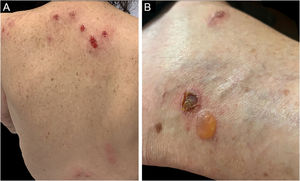 Dermatose eosinofílica em portadores de LLC. (A) Placas eritemato‐edematosas no dorso com exulceração no dorso alto decorrentes do ato de coçadura pelo prurido intenso. (B) Forma bolhosa com lesão semelhante ao penfigoide bolhoso.