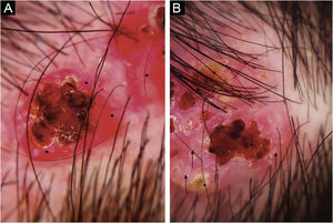 (A) Projeção papilomatosa de cor vermelha com ulceração central sobre fundo eritematoso e vasos polimórficos na periferia da lesão (asteriscos). (B) Outra lesão com múltiplas ulcerações, crostas amarelo‐esbranquiçadas (asterisco) e pequenos círculos brancos (seta) na periferia.