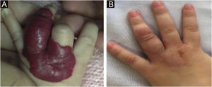 (A) Antes do início do tratamento, com 8 semanas de idade. (B) Após o tratamento, aos 20 meses de idade (Paciente n° 98).