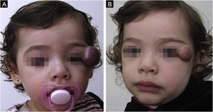 (A) Início do tratamento, aos 9 meses de idade. (B) Pequena resposta aos 20 meses, quando o propranolol foi suspenso. Tratamento cirúrgico foi necessário (paciente n° 1).