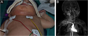 Imagens clínicas e radiológicas do hemangioendotelioma kaposiforme (HEK). (A) Imagem clínica de apresentação: lesão de tipo vascular localizada em região cervical direita e tórax. (B) Imagem radiológica de tumor vascular compatível com HEK com extensão endocervical profunda.