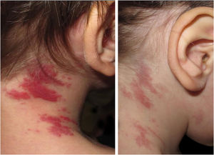 Imagens clínicas de lesões de angioma em tufos (AT). (A) Máculas e placas violáceas na face lateral direita do pescoço aos 2 anos de idade; primeira apresentação de AT quando da descontinuação de aspirina e ticlopidina. (B) Regressão parcial após reintrodução de aspirina em monoterapia.