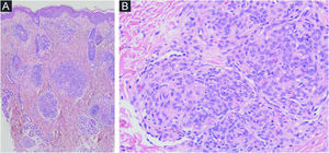 Características histopatológicas do angioma em tufos (AT). (A), Proliferação vascular na derme papilar e média; os nódulos eram compostos por vasos agrupados em tufos revestidos por células endoteliais. Essas células endoteliais eram positivas para Fator VIII, CD31 e CD34 (negativas para podoplanina). (B) Esses nódulos eram circundados na periferia por espaços vasculares semilunares (positivos para podoplanina).