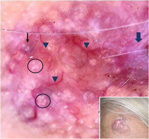 Nódulo róseo brilhante na região frontal direita (canto inferior direito); a dermatoscopia com luz polarizada mostrou véu azul/cinza esbranquiçado (seta preta fina), torrões e pontos brancos brilhantes semelhantes a rosetas (círculos), vasos arborizados (pontas de seta) e estrias brancas brilhantes (seta grossa).