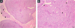(A) Nódulos de diferentes tamanhos (setas), os maiores representando principalmente o componente espiroadenomatoso (Hematoxilina & eosina, 40×). (B) Maciços celulares englobando estruturas ductais com revestimento em dupla camada de células e produto de secreção intraluminal (pontas de seta; Hematoxilina & eosina,100×).