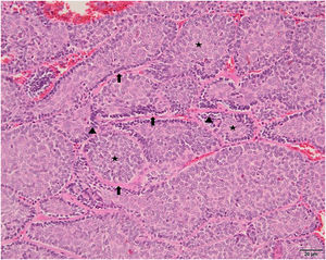 Arranjo em quebra‐cabeça de maciços celulares circundados de maneira incompleta por material eosinofílico semelhante a membrana basal (setas). Células basófilas periféricas em paliçada (pontas de seta) e células mais claras localizadas centralmente (asteriscos; Hematoxilina & eosina, 200×).