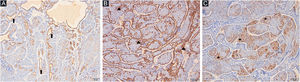 (A) Positividade para CK5/6 em áreas com diferenciação ductal (setas; CK5/6 100×). (B) Camada periférica de células mioepiteliais (pontas de seta; actina de músculo liso, 100×). (C) Células dendríticas intratumorais (asteriscos; S100 100×).
