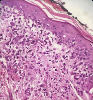 Dermatite crônica associada à presença de células sugestivas de células de Langerhans (Hematoxilina & eosina, × 400).