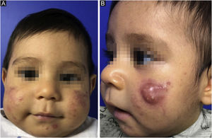 Acne infantil. (A) Aos 2 meses de idade, pápulas, pústulas e comedões na face. (B) Aos 7 meses, mesmo com a terapia instituída, com cisto drenante, cicatrizes, e lesões papulopustulosas ativas.