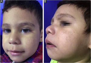 Acne infantil tratada com isotretinoína oral. (A/B) Um ano após o término do tratamento com isotretinoína oral, evidenciando cicatrizes residuais normocrômicas.