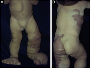 (A) Malformações vasculares no membro inferior esquerdo. Deformidades nas pernas e pés e tumoração abdominal. (B) Malformações vasculares extensas no tórax, quadril e coxas com distribuição em mosaico.