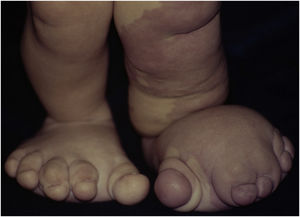 Detalhes das deformidades dos pés com gigantismo assimétrico e sindactilia.