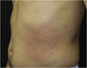Placa eritematosa com centro papular na região abdominal esquerda.