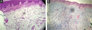 (A) Depósitos de mucina na derme superior e média, sem proliferação fibroblástica associada, ausência de material amiloide (Hematoxilina & eosina, 40×). (B) Depósito de mucina evidenciado (Alcian Blue, 40×).
