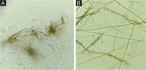 Caso 1. (A) Hifas acastanhadas septadas (Borelli spider). Exame micológico direto, KOH 20% + DMSO, 40×. (B) Micromorfologia evidenciando hifas acastanhadas, septadas, de onde partem conidióforos com conídios alongados em sua extremidade, dando aspecto de cajado nodoso. Rhinocladiella sp., lactofenol, 40×.