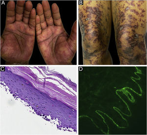 Caso 2. (A) Lesões liquenoides com vesículas dispersas nas mãos. (B) Lesões liquenoides com vesículas dispersas nas coxas. (C) Dermatite de interface observado na histopatologia. (D) Deposição linear de C3 ao longo da zona da membrana basal epidérmica.