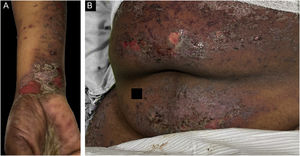 Caso 3. (A) Lesões liquenoides descamativas e bolhosas nos punhos. (B) Lesões liquenoides descamativas e bolhosas no abdome.