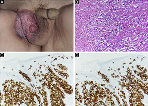 (A) Achados clínicos de DPEM primária. Erupção cutânea e lesões elevadas a região escrotal direita. (B) DPEM primária: as células neoplásicas proliferam individualmente e em arranjo alveolar na camada basal da epiderme e infiltram a derme. As células tumorais têm vesículas de cor pálida e os núcleos têm formato irregular e distribuição desigual (Hematoxilina & eosina, 200×). (C) Imunomarcação positiva para CK7 (CK7 200×). (D) Imunomarcação positiva para CAM2.5 (CAM2.5, 200×).