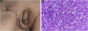 Achados clínicos. (A) Observa‐se massa subcutânea na região inguinal direita. (B) Células atípicas com citoplasma pálido em lesão de rápido crescimento; os achados são semelhantes aos da doença de Paget invasiva anterior (Hematoxilina & eosina, 400×).