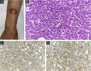 (A) Achados clínicos: observa‐se tumoração subcutânea que era dolorosa no antebraço direito. (B) Proliferação difusa de pequenas células arredondadas atípicas na derme profunda (Hematoxilina & eosina, 200×). (C) Imunomarcação positiva para CD20 (MYC, 400×). (D) Imunomarcação positiva para CD79a (BCL‐2, 400×).