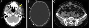 Achados de tomografia computadorizada. (A) Tumor de partes moles no seio maxilar esquerdo (seta amarela). (B) Alterações osteolíticas no crânio (setas brancas). (C) Múltiplas metástases abdominais subcutâneas e intraperitoneais.