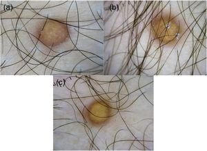(A‐C) A dermatoscopia revela áreas homogêneas amarelas, rede branca central e halo rosado.
