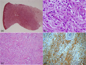 (A) Lesão hipercelular com aumento de fibras colágenas estendendo‐se da derme superficial à derme profunda (Hematoxilina & eosina, 5×). (B) Células histiocíticas com citoplasma vacuolar observadas entre fibras colágenas densas (Hematoxilina & eosina, 400×). (C) Aprisionamento de colágeno na periferia da lesão (Hematoxilina & eosina, 200×). (D) Células com citoplasma vacuolar com expressão de CD68 (20×).