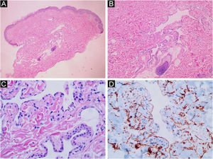 Síndrome de Blue Rubber Bleb Nevus. Espaços capilares dilatados, limitados por fina camada de células endoteliais. (A) Hematoxilina & eosina, 40×. (B) Hematoxilina & eosina, 100×. (C) Hematoxilina & eosina, 400×. (D) Imuno‐histoquímica positiva para o anticorpo CD34, evidenciando o endotélio vascular (400×).