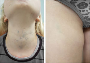 Glomangiomas. Múltiplas lesões vasculares na região cervical e uma única lesão palpável na coxa direita.