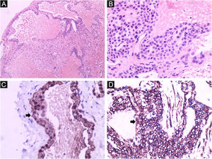 Glomangioma. Espaços vasculares dilatados e presença de células glômicas revestindo o endotélio. (A) Hematoxilina & eosina, 100×. (B) Hematoxilina & eosina, 400×. (C) Imuno‐histoquímica positiva para actina de músculo liso (SMA, 400×). (D) Imuno‐histoquímica positiva para Caldesmon (Caldesmon, 400×).