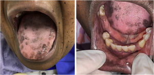 Aspecto clínico de manchas hiperpigmentadas em região oral e perioral, localizadas em língua, lábio e fundo de vestíbulo.