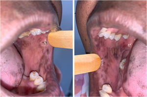 Aspecto clínico de manchas hiperpigmentadas em mucosa jugal bilateral e bordas de língua.