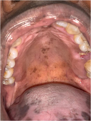 Manchas hiperpigmentadas em palato duro.