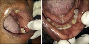Amenização das manchas pigmentadas em mucosa oral, em momento de pausa na medicação.