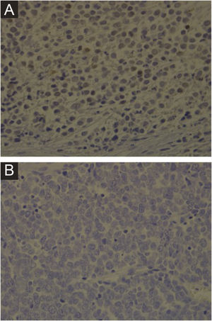 Imuno‐histoquímica para MCPyV realizada em lâminas de carcinoma de células de Merkel. (A) Lâmina de imuno‐histoquímica de paciente apresentando resultado positivo para MCPyV (aumento de 400×). (B) Lâmina de imuno‐histoquímica de paciente apresentando resultado negativo para MCPyV (aumento de 400×).