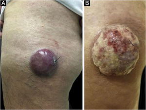 Carcinoma de células de Merkel localizado na coxa esquerda de paciente do sexo masculino. (A) Ao diagnóstico, lesão tumoral com aspecto cupuliforme, com eritema e discreta descamação. (B) Evolução do tumor com crescimento e ulceração em toda a lesão. Fonte: Cortesia da Dra. Gabriella Campos‐do‐Carmo. O paciente consentiu com o uso das imagens para fins educacionais.