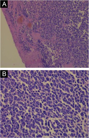 Histopatologia do carcinoma de células de Merkel com coloração Hematoxilina & eosina. (A) Cordões de células tumorais na derme (aumento de 200×). (B) As células tumorais apresentam citoplasma escasso e núcleos redondos ou irregulares (aumento de 400×).