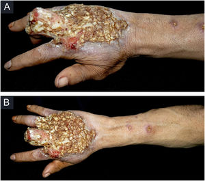 (A) Úlcera em dorso da mão direita recoberta por crostas amareladas, bordos nítidos e eritematosos que se estendiam até as falanges, com deformidade anatômica do terceiro quirodáctilo. (B) Nódulos ulcerados dispostos em trajeto linfático ascendente em antebraço direito.