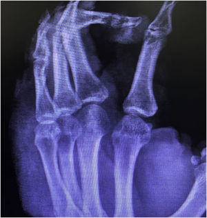 Radiografia da mão direita. Presença de sequestro ósseo, destruição do córtex da falange distal e média do terceiro quirodáctilo sugestiva de osteomielite crônica.