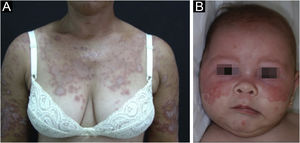 (A) Lúpus eritematoso cutâneo subagudo: placas eritemato‐papuloescamosas anulares confluentes no tórax e nos membros superiores. (B) Lúpus eritematoso neonatal: placas eritematosas circulares e policíclicas na face.