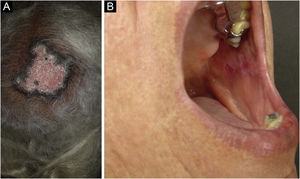 Lúpus eritematoso cutâneo crônico. (A) Forma discoide localizada no couro cabeludo, com alopecia cicatricial. (B) Forma discoide afetando a mucosa jugal.