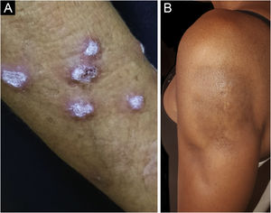 Lúpus eritematoso cutâneo crônico. (A) Variante verrucosa localizada no membro superior. (B) Paniculite lúpica acometendo o braço e evoluindo com lipoatrofia.