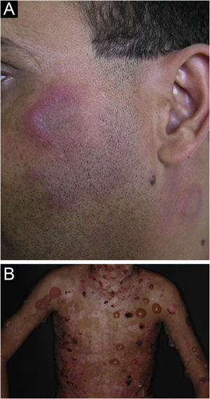 (A) Lúpus eritematoso túmido: lesões eritemato‐edematosas arciformes e anulares na face e região cervical. (B) Lúpus eritematoso bolhoso: lesões bolhosas, ulcerocrostosas hemáticas e lesões residuais hipocrômicas, localizadas na região cervical, tronco, axilas e membros superiores.