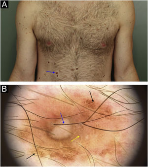 Melanoma extensivo superficial com 0,5 mm de invasão na região de hipocôndrio direito. (a) Aspecto clínico e localização da lesão (seta). (b) Aspecto dermatoscópico onde se observam áreas de rede pigmentar atípica (seta preta), área com hipopigmentação reticulada (seta amarela) e área central despigmentada/amorfa com vasos lineares e irregulares em permeio (seta azul).