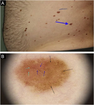 Melanoma in situ no flanco esquerdo. (a) Aspecto clínico do melanoma, em que são observadas características semelhantes às demais lesões adjacentes (seta azul). (b) Na dermatoscopia pode ser observada rede pigmentada irregular (setas pretas) associada à hipopigmentação reticulada ou rede invertida (seta azul) e vasos sanguíneos puntiformes periféricos (seta verde).