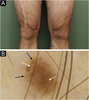 Melanoma in situ na região anteromedial do membro inferior esquerdo. (a) Aspecto clínico de lesão de 1,5 mm (seta azul), com coloração marrom‐clara semelhante às demais áreas pigmentadas nas proximidades de ambos os membros inferiores. (b) Aspecto dermatoscópico da lesão onde foi possível identificar uma lesão mais ou menos simétrica, com coloração marrom‐clara, contendo glóbulos periféricos com distribuição e tamanhos irregulares (seta preta); vasos com formas lineares, em vírgula e globulares em permeio (seta branca).