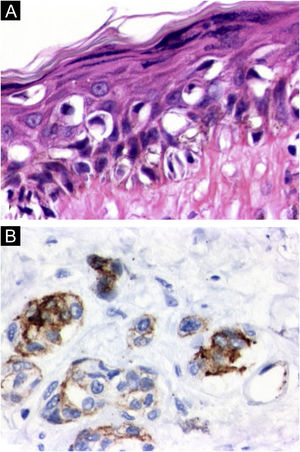 Cortes histológicos. (a) Fotomicroscopia do melanoma in situ da perna esquerda demonstrando atipias citológicas intensas e disseminação pagetoide exuberante (Hematoxilina & eosina, 100×). (b) Positividade imuno‐histoquímica de HMB45 nas células neoplásicas em ambos os componentes epidérmico e dérmico do melanoma invasivo da região do abdome (Hematoxilina & eosina, 100×).